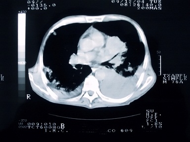 Lung CT scan 4-11-12