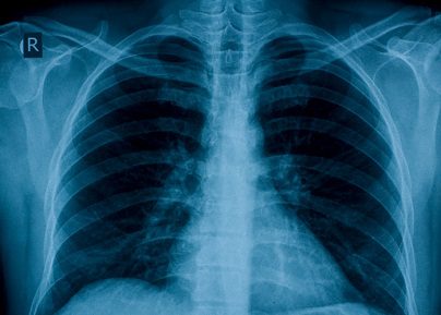 Annual Chest X-Rays Don’t Reduce Lung Cancer Death Rate - Partnership ...